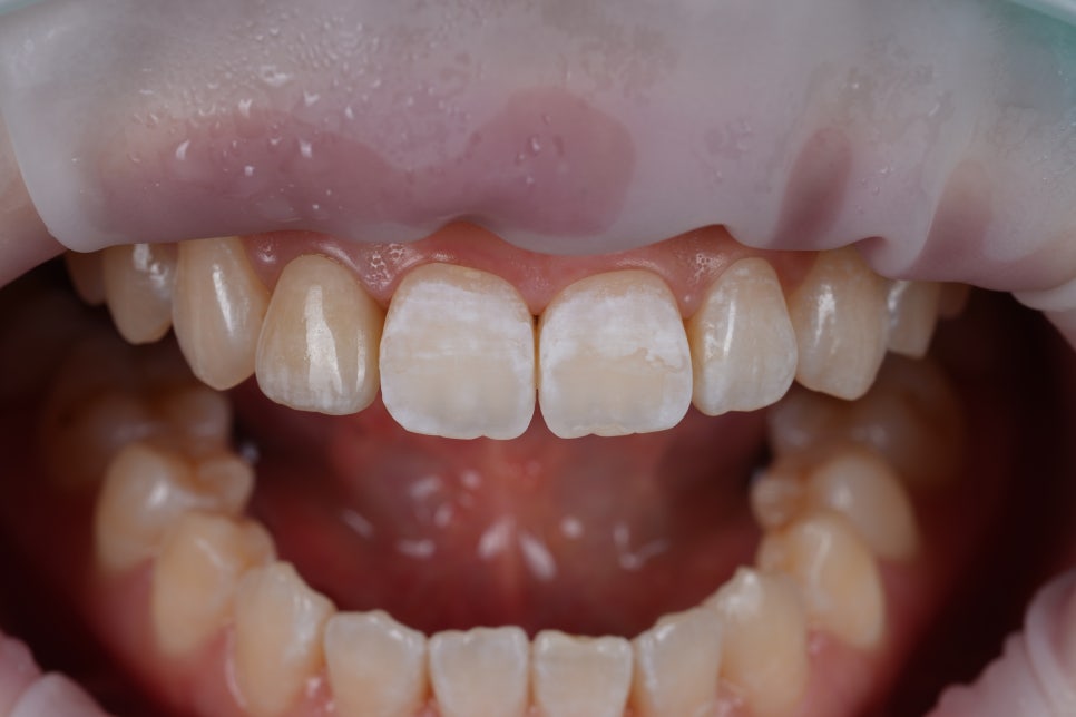 앞니 갈색 반점, 무삭제로 얼룩 제거 시술 : 아이콘 침투 관련 이미지 5