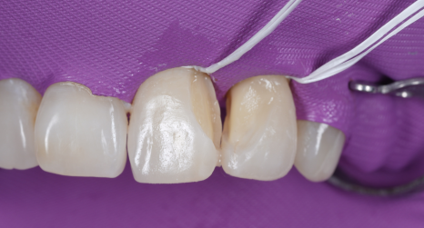 잘못된 앞니 레진 뼈까지 녹인다? 레진 재치료 과정 관련 이미지 12