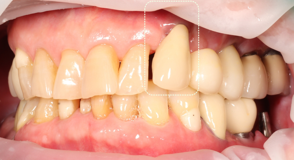 선릉역치과 타원 앞니 임플란트 빼고 재수술 해드린 이유 관련 이미지 6