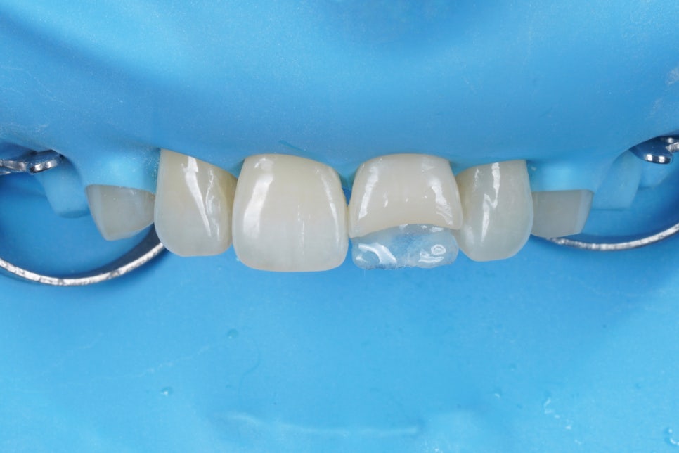 서울 앞니 레진으로 40분 안에 자연스럽게 복원한 케이스 관련 이미지 5