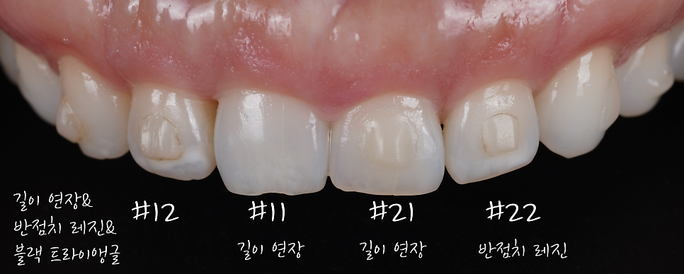 신사역치과 미국에서 교정 중이던 분 앞니 레진으로 고민 해결 관련 이미지 6