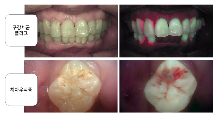 Gangnam Dental Clinic: You Wanted an Extraction, but We Preserved the Tooth with Root Canal Treatment + Overlay image 9