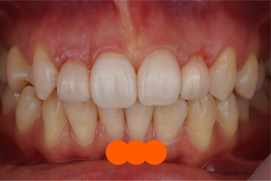 왜소치 레진 라미네이트, 당일 치료 완료! Direct composite veneer하는 서초동 치과 관련 이미지 5