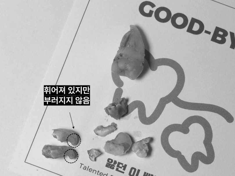 사랑니발치 매복 돼도 이렇게 빼면 안전해요 관련 이미지 8