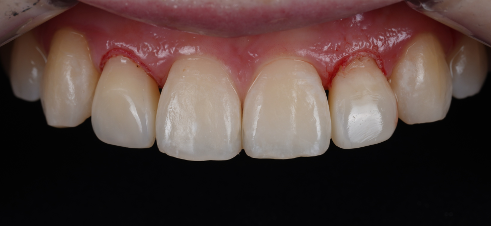 Seocho Dental Clinic Case of Gummy Contouring and Resin Treatment for a Peg Lateral Tooth in an Out-of-Town Dental Hygienist image 8