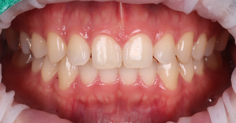 Apgujeong Dental Clinic: 3 Things Needed for Successful Resin Treatment of Peg Laterals image 3
