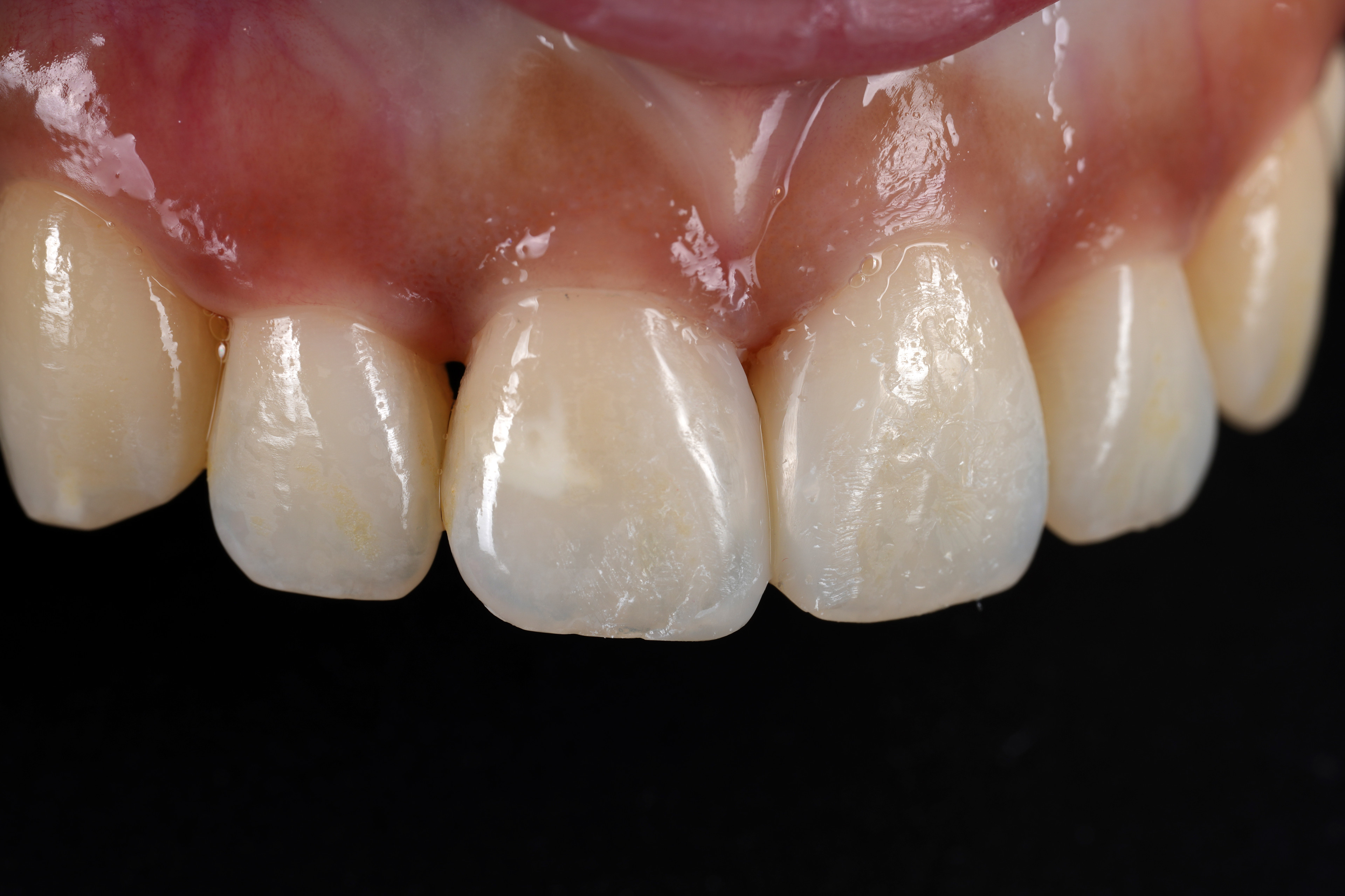 교대역 재주좋은치과 앞니 레진 비용이 저렴하지 않은 이유 관련 이미지 4