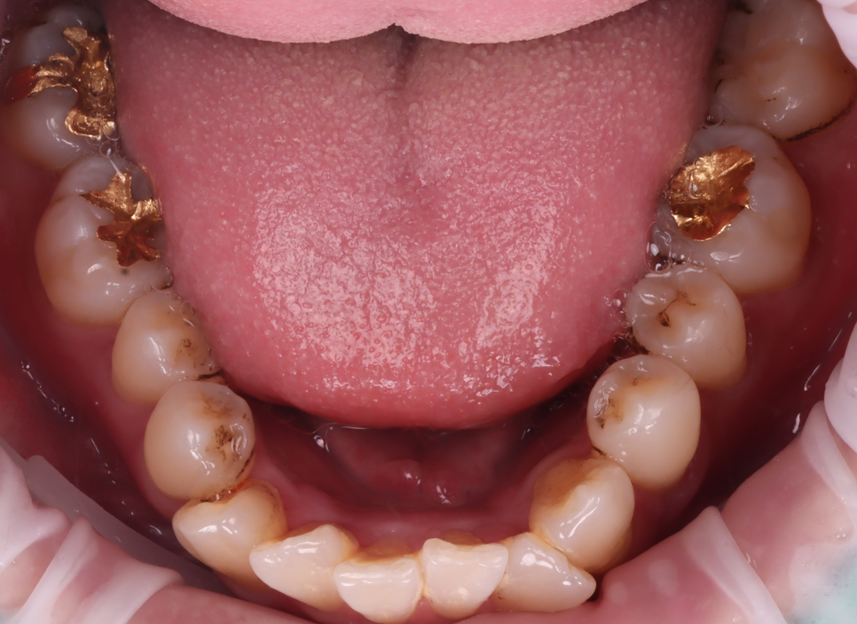 서초동치과 착색 고민되면 에어플로우 하세요 관련 이미지 4