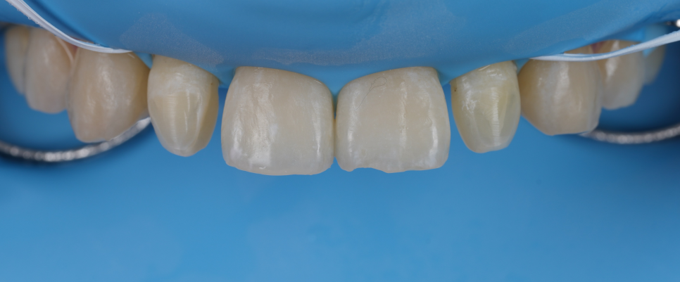 왜소치 라미네이트보다 레진 비니어를 더 추천드리는 이유 관련 이미지 11