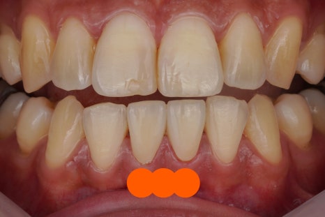 교대역 충치 치과, 신경치료 진단은 보수적으로 접근합니다. 관련 이미지 15