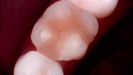 교대역 치과 보철 아래 2차 충치를 다시 레진으로 관련 이미지 14