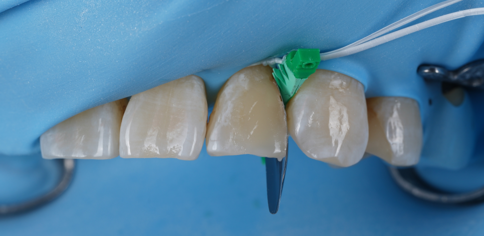 서초구치과 레진 탈락 재치료 2가지가 성공 핵심입니다 관련 이미지 8