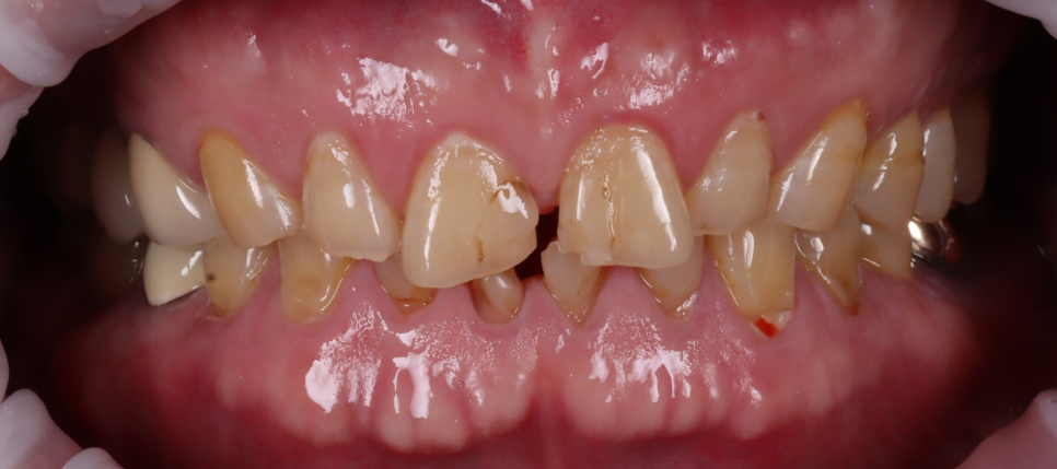 신논현역치과 심하게 마모된 60대 남성 앞니 크라운 치료 관련 이미지 3