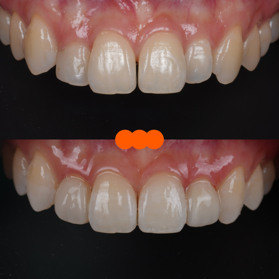 왜소치레진 20년 전에 했던 치아 재치료 후 반대쪽까지 관련 이미지 17