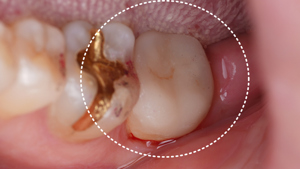 Gangnam Dental Clinic: You Wanted an Extraction, but We Preserved the Tooth with Root Canal Treatment + Overlay image 17