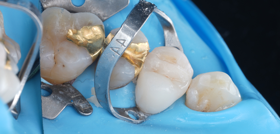 교대치과 신경치료 후 크라운 안 하고 오버레이로 보존 관련 이미지 14