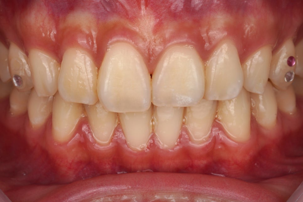 강남역 근처 치과, 투스젬 제거는 여기로 와야합니다 관련 이미지 1