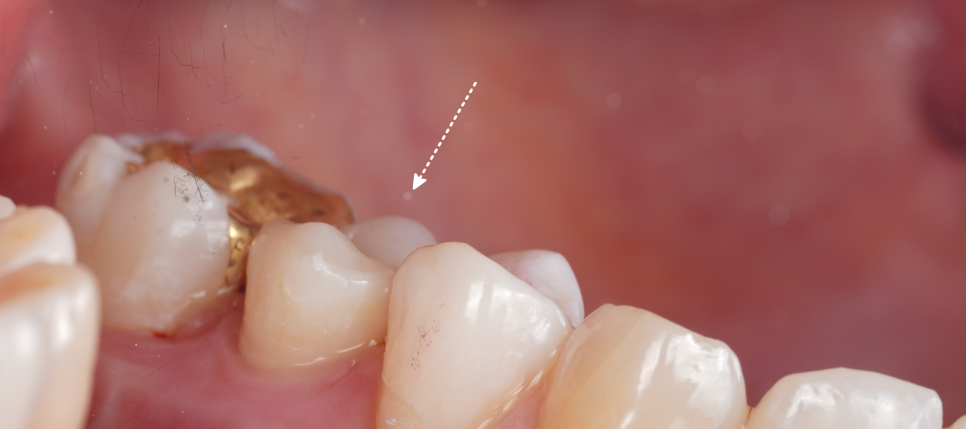 신경치료 후 크라운 안 하고 레진으로 할 수 있어요 관련 이미지 11