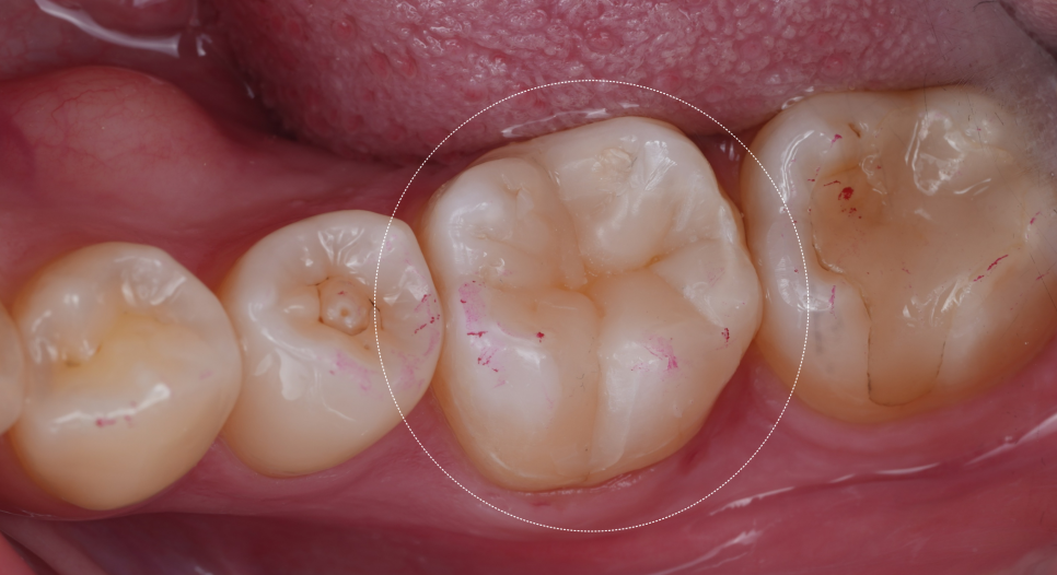 인레이치료 하방 2차 충치 레진 빌드업 사례 관련 이미지 17