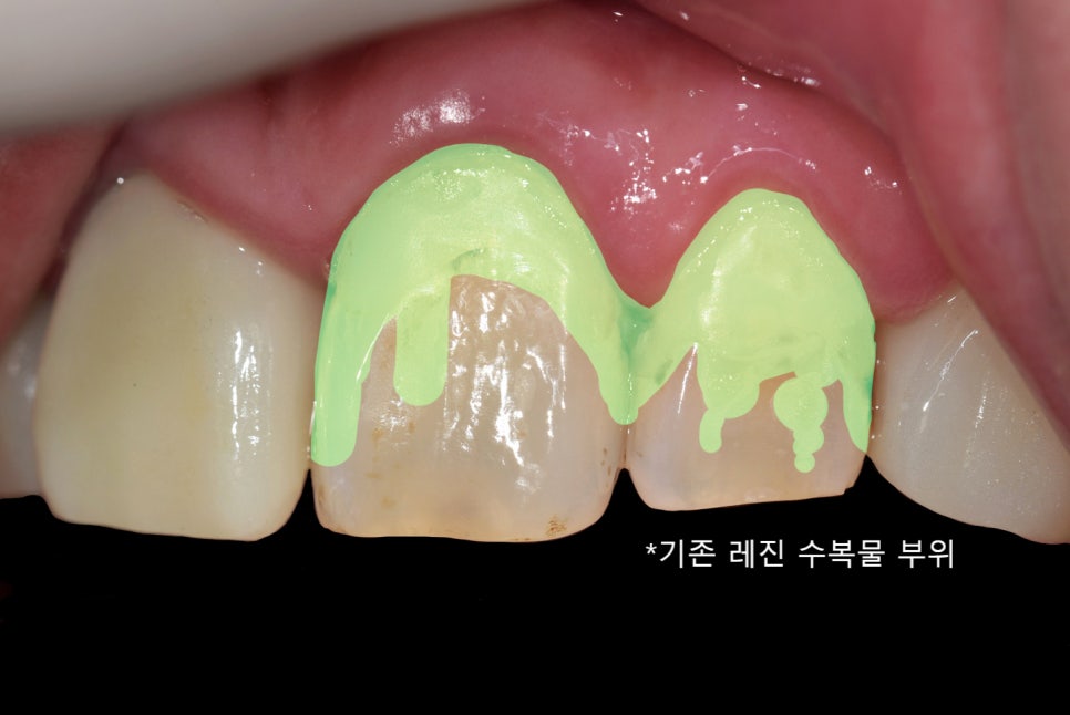앞니 사이 충치, 앞니 레진 변색 재치료 이야기 관련 이미지 2