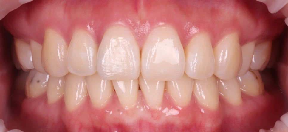 교대역치과 타치과 신경치료, 크라운 진단받았으나 레진으로 치료 관련 이미지 2