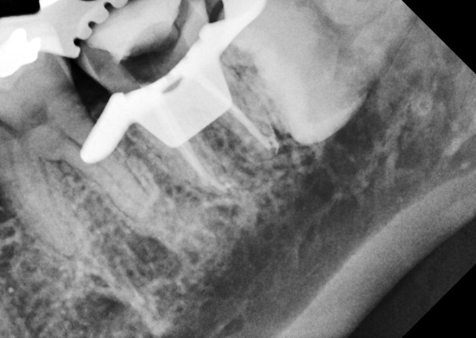 교대역 어금니 크랙 깨짐으로 씹을때 통증, 발치 피하고 신경치료로 유지한 케이스 관련 이미지 7