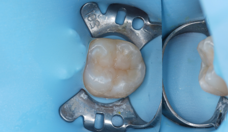 서초동치과 치아 삭제 원하지 않는다면 오버레이 하세요 관련 이미지 3