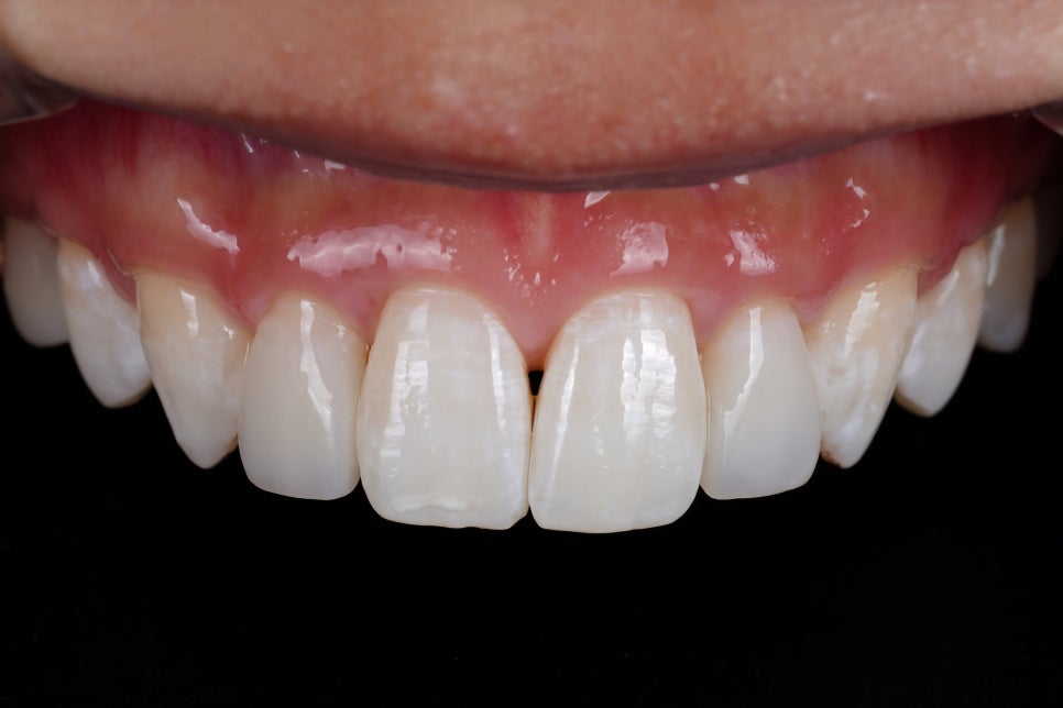 앞니 레진 라미네이트, 1시간 원데이 치료가 가능한 교대 치과 관련 이미지 4