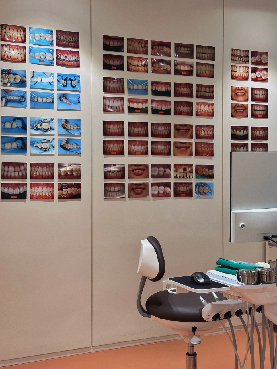 앞니 크라운 재치료 시니어에게 더 중요한 이유 관련 이미지 11