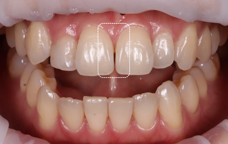 왜소치레진 20년 전에 했던 치아 재치료 후 반대쪽까지 관련 이미지 6