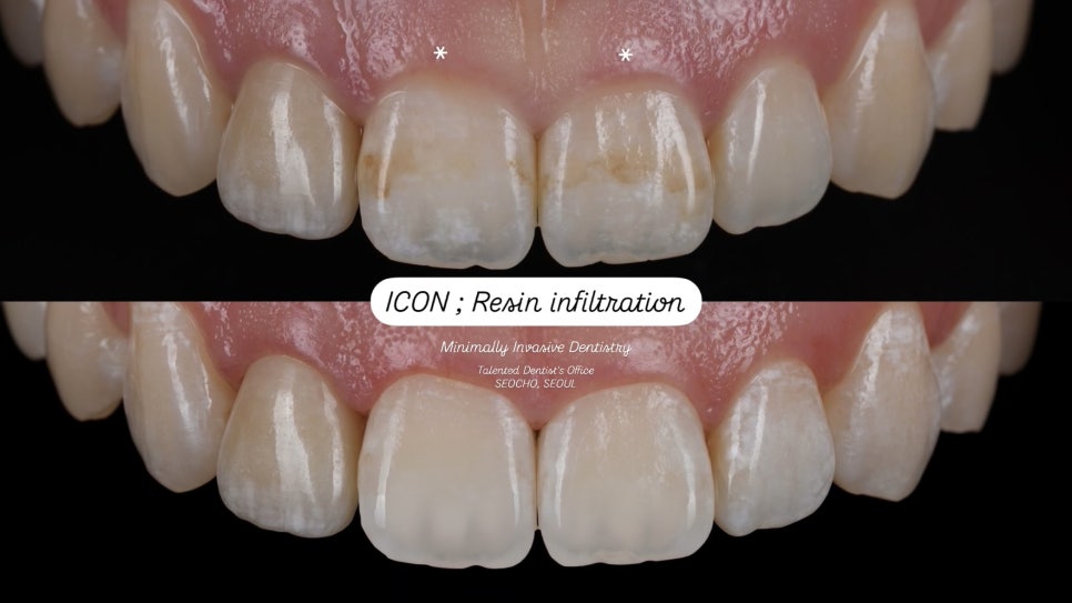 앞니 갈색 반점, 무삭제로 얼룩 제거 시술 : 아이콘 침투 관련 이미지 3