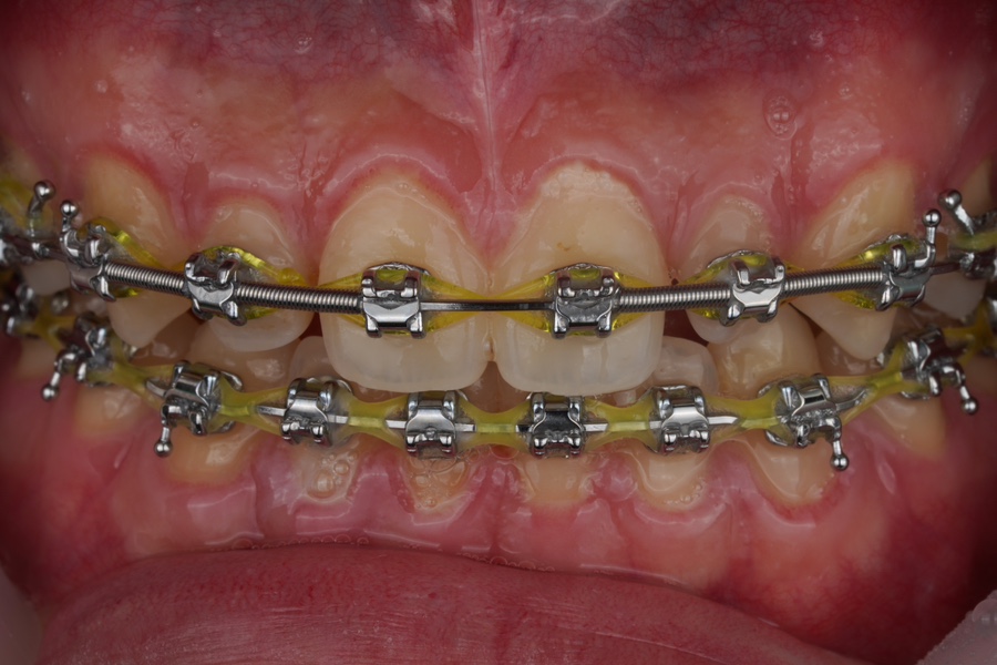 왜소치 레진 비니어, 교정 마무리 할 때 오시면 참 좋습니다. 관련 이미지 1
