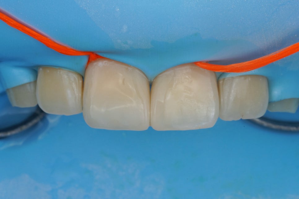 앞니 벌어짐을 레진 비니어로 당일 치료한 서초동 치과 관련 이미지 7