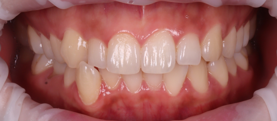 Jamnwon-dong Dental Clinic: Don’t Grind Down Your Teeth—Get Resin Build-up Instead image 1
