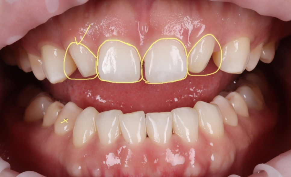 왜소치 라미네이트보다 레진 비니어를 더 추천드리는 이유 관련 이미지 3