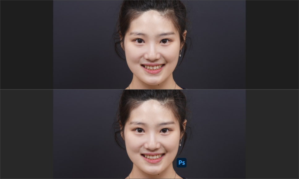 앞니 벌어짐 레진 비니어 후 미인대회 출전 관련 이미지 6