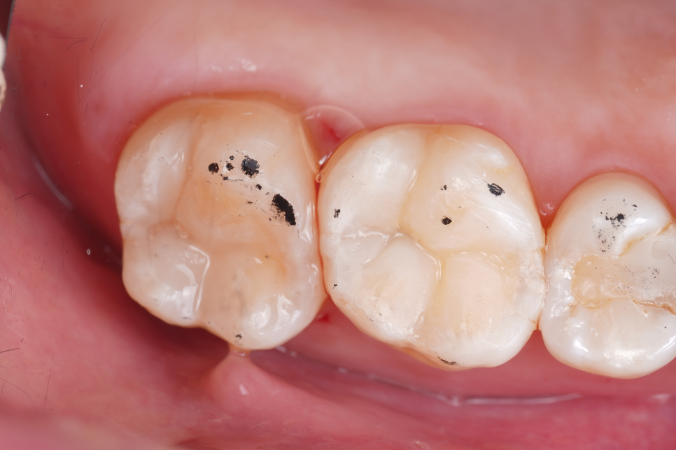 치과보존과 치아를 덜 깎는 치료를 지향하는 이유 관련 이미지 14