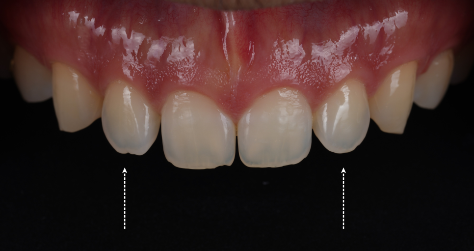Apgujeong Dental Clinic: 3 Things Needed for Successful Resin Treatment of Peg Laterals image 1