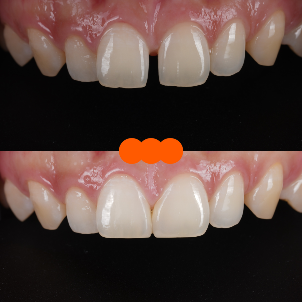 레진치료의 수명 라미네이트와 비교해 볼게요 관련 이미지 2