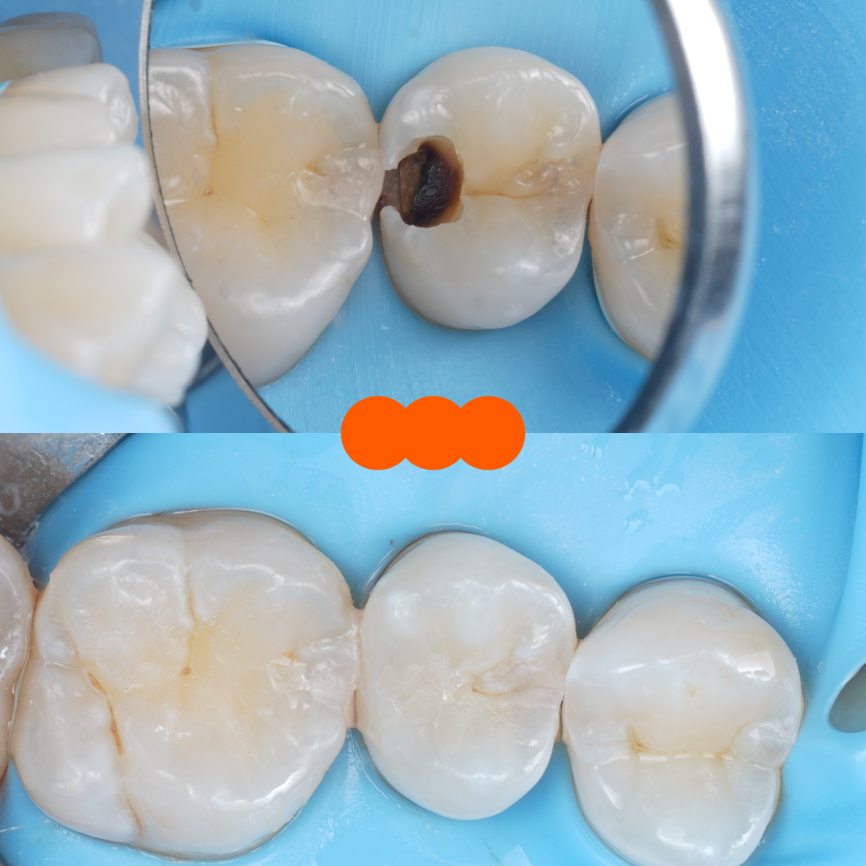 서초역치과 이걸로 신경치료 미뤄드리고 있어요 관련 이미지 13