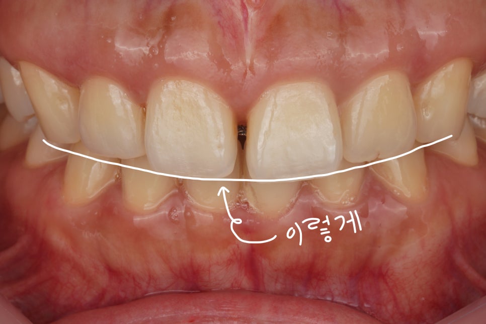 앞니 벌어짐을 레진 비니어로 당일 치료한 서초동 치과 관련 이미지 2