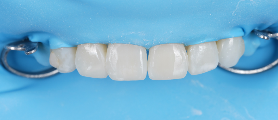 신사역치과 미국에서 교정 중이던 분 앞니 레진으로 고민 해결 관련 이미지 10