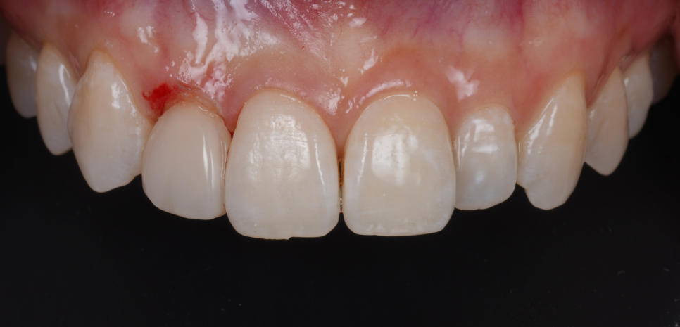 왜소치레진 20년 전에 했던 치아 재치료 후 반대쪽까지 관련 이미지 12