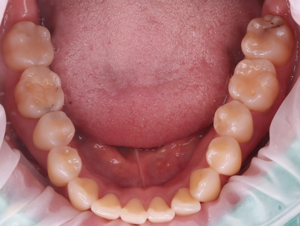 교대역 치과 보철 아래 2차 충치를 다시 레진으로 관련 이미지 4