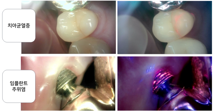 Gangnam Dental Clinic: You Wanted an Extraction, but We Preserved the Tooth with Root Canal Treatment + Overlay image 8