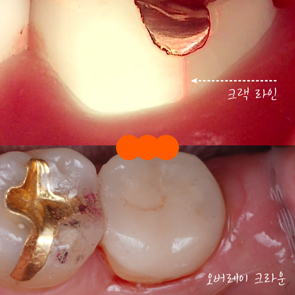 Gangnam Dental Clinic: You Wanted an Extraction, but We Preserved the Tooth with Root Canal Treatment + Overlay image 18