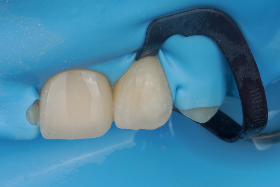 서초동 앞니 사이 충치, 기존 레진 제거 후 다시 치료 했습니다. 관련 이미지 4