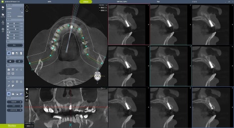 왜 재주좋은치과 호랑플란트&trade;로 치료해야 하나요? 서초동 임플란트 고민 해결 관련 이미지 3