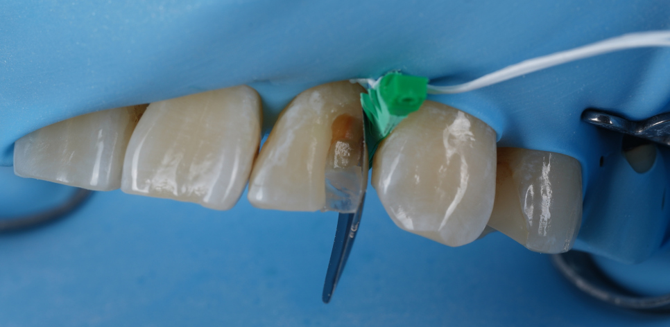 서초구치과 레진 탈락 재치료 2가지가 성공 핵심입니다 관련 이미지 7