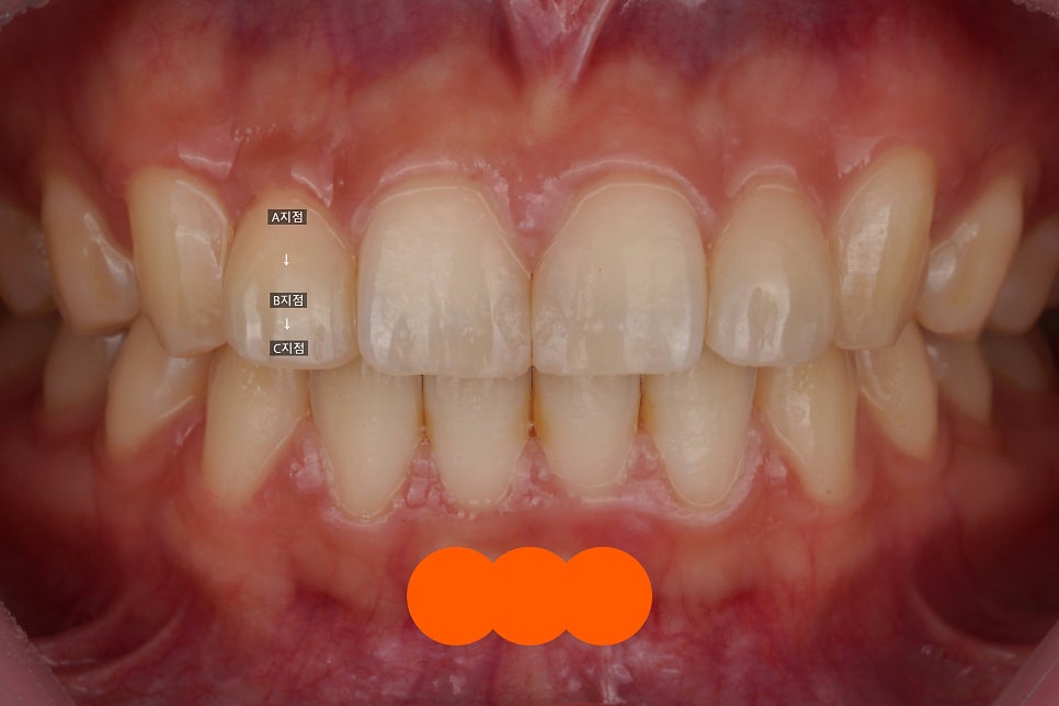 서초/강남 왜소치 레진 비니어, 당일 치료해주는 치과 Direct Composite Veneer in Korea 관련 이미지 5